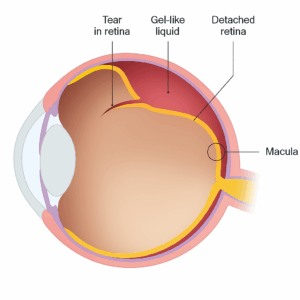 Retinal Detachment