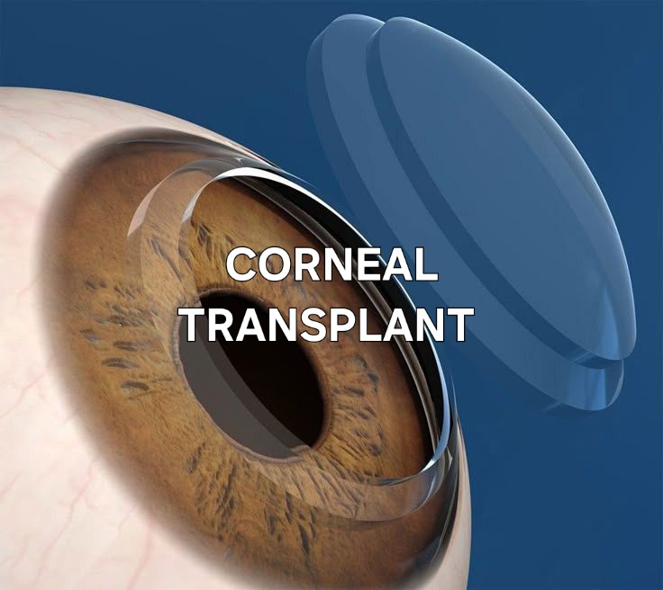 Corneal Transplant