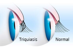 Trichiasis